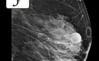 Biopsies mammaires : pourquoi et comment les réaliser ?